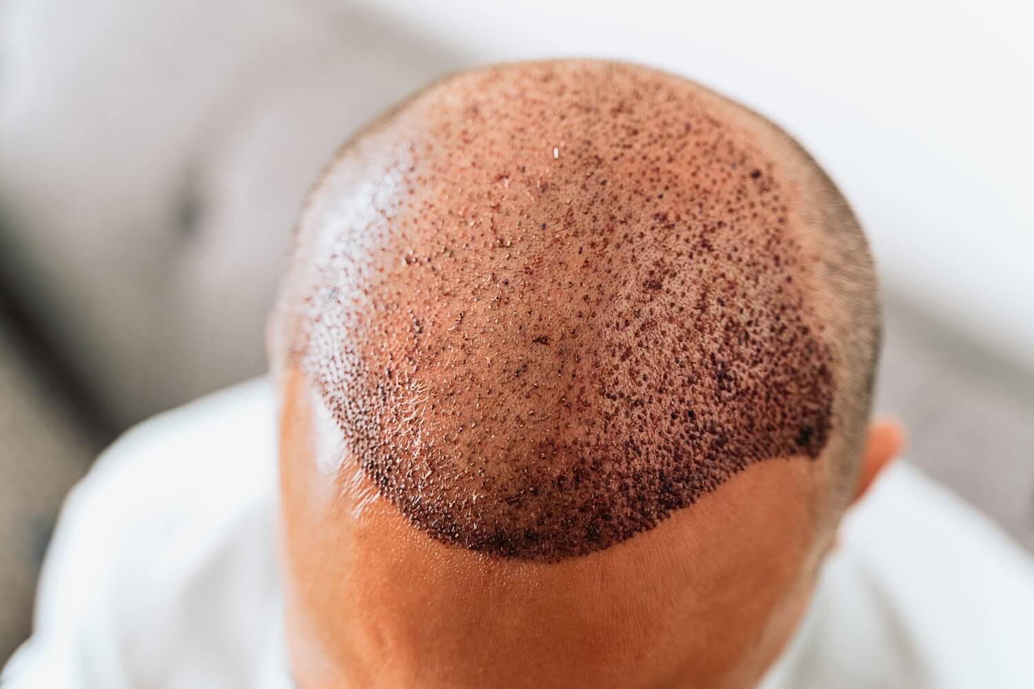 Pain Management During and After Hair Transplant Surgery